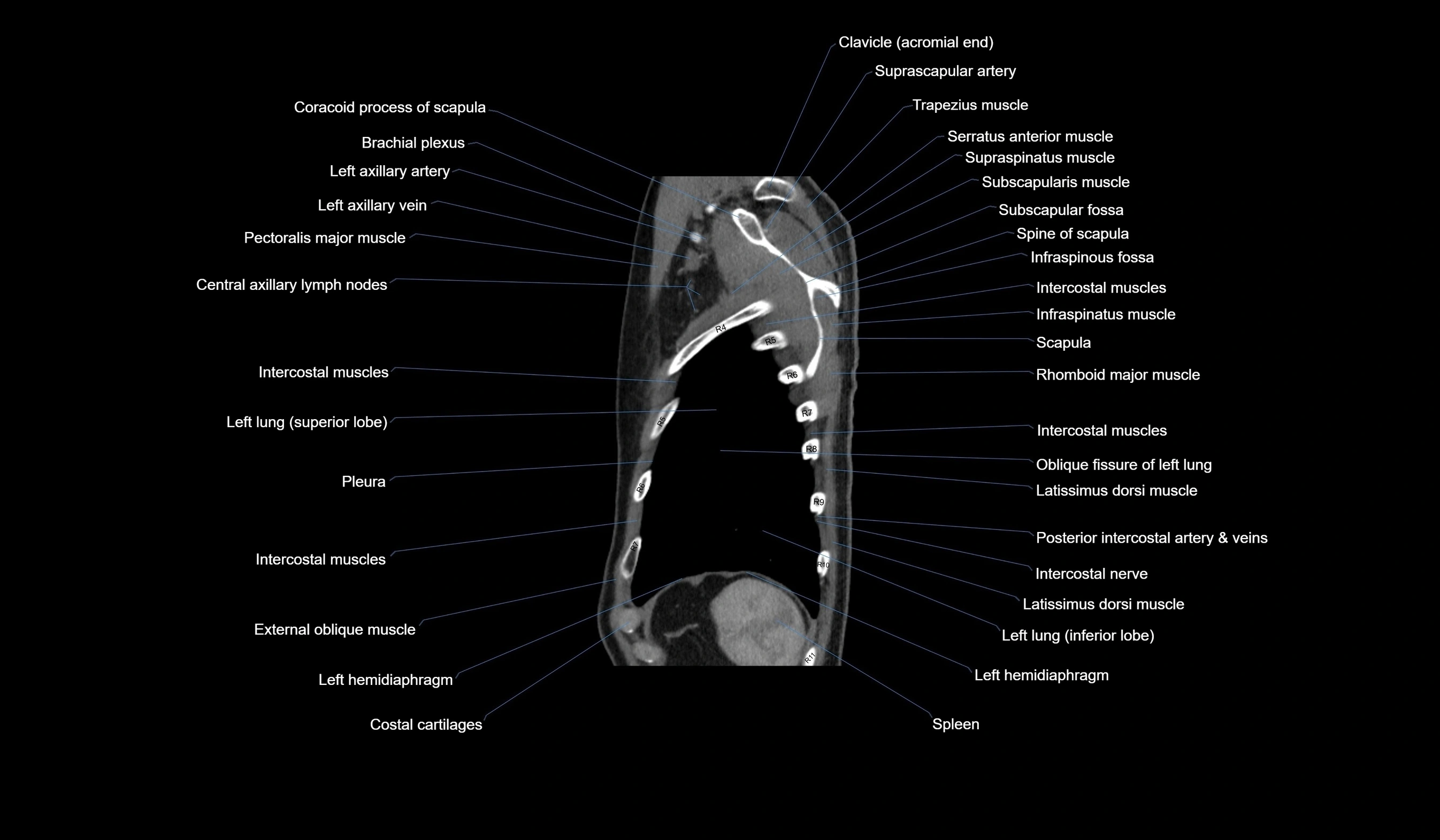 CT chest (thorax) labelled sagittal cross sectional anatomy radiology image-00123.webp